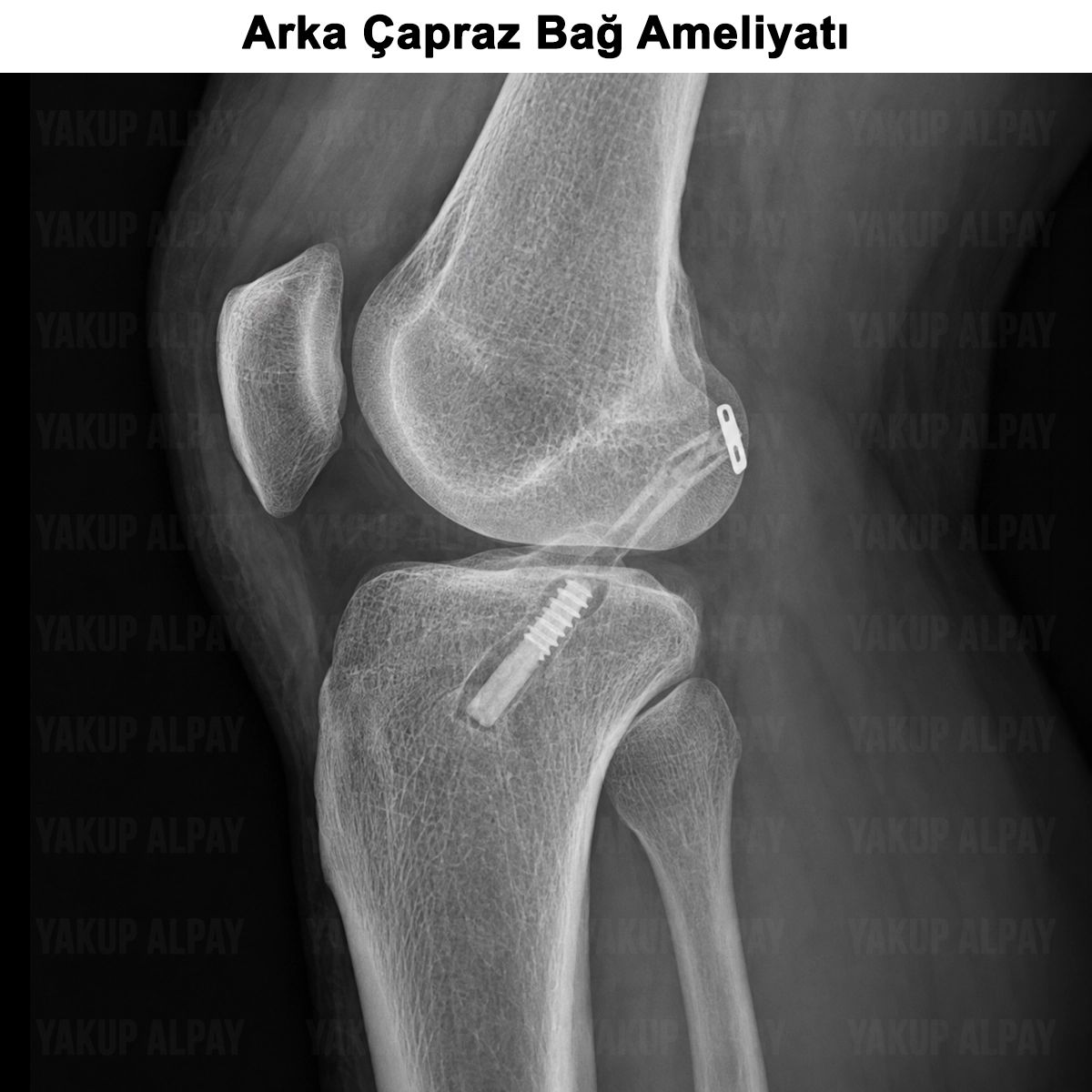 Arka Çapraz Bağ Yaralanması: Tedavisi ve Ameliyatı