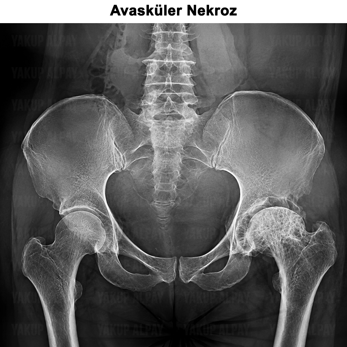 Avasküler Nekroz