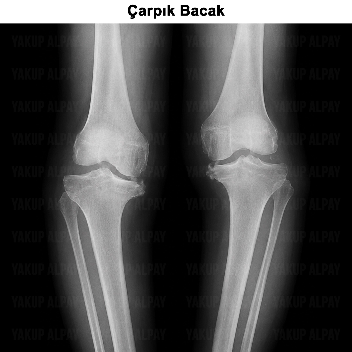 Çarpık Bacak: Nedir? Tedavisi? Ameliyat Riskleri?