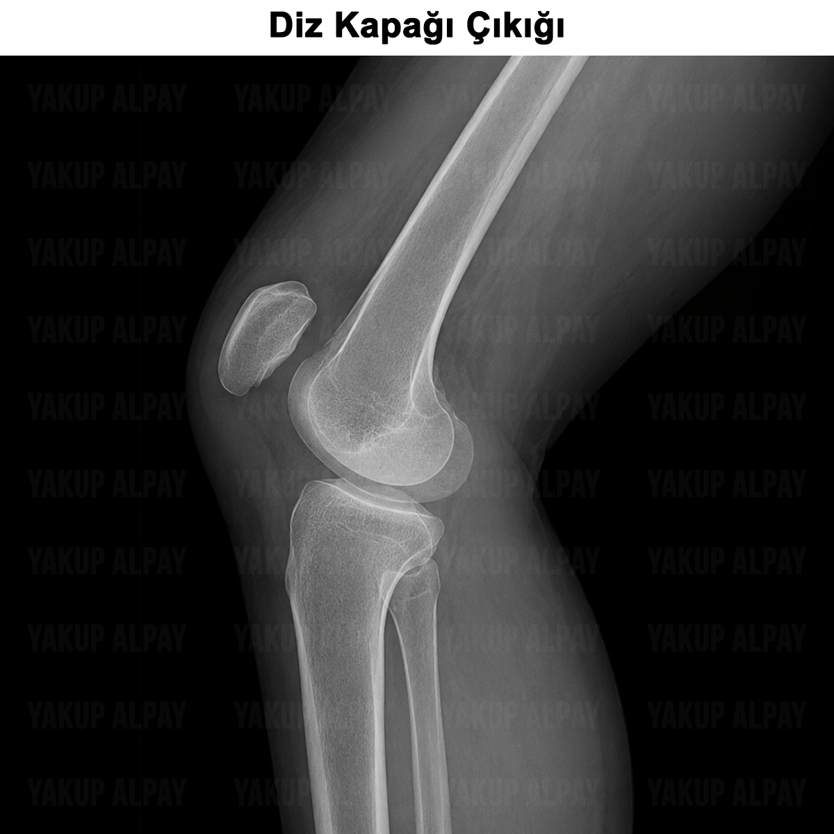 Diz Kapağı Çıkığı: Nedir? Neden Olur? Belirtileri?