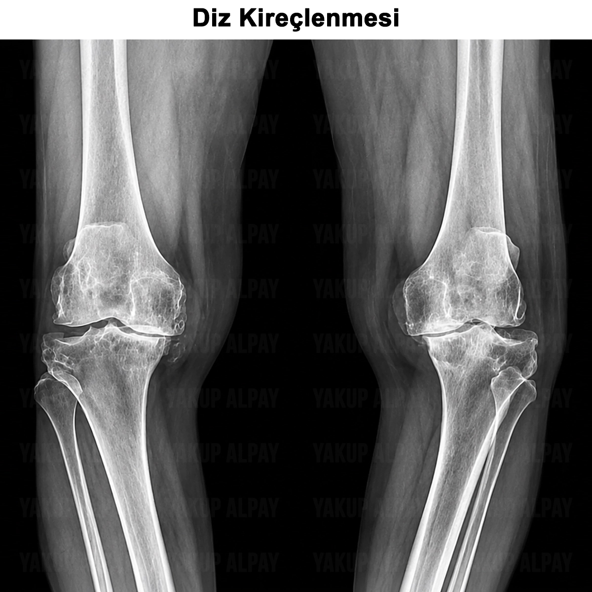 Diz Kireçlenmesi (Gonartroz): Nedir? Neden Olur? Ameliyatı?