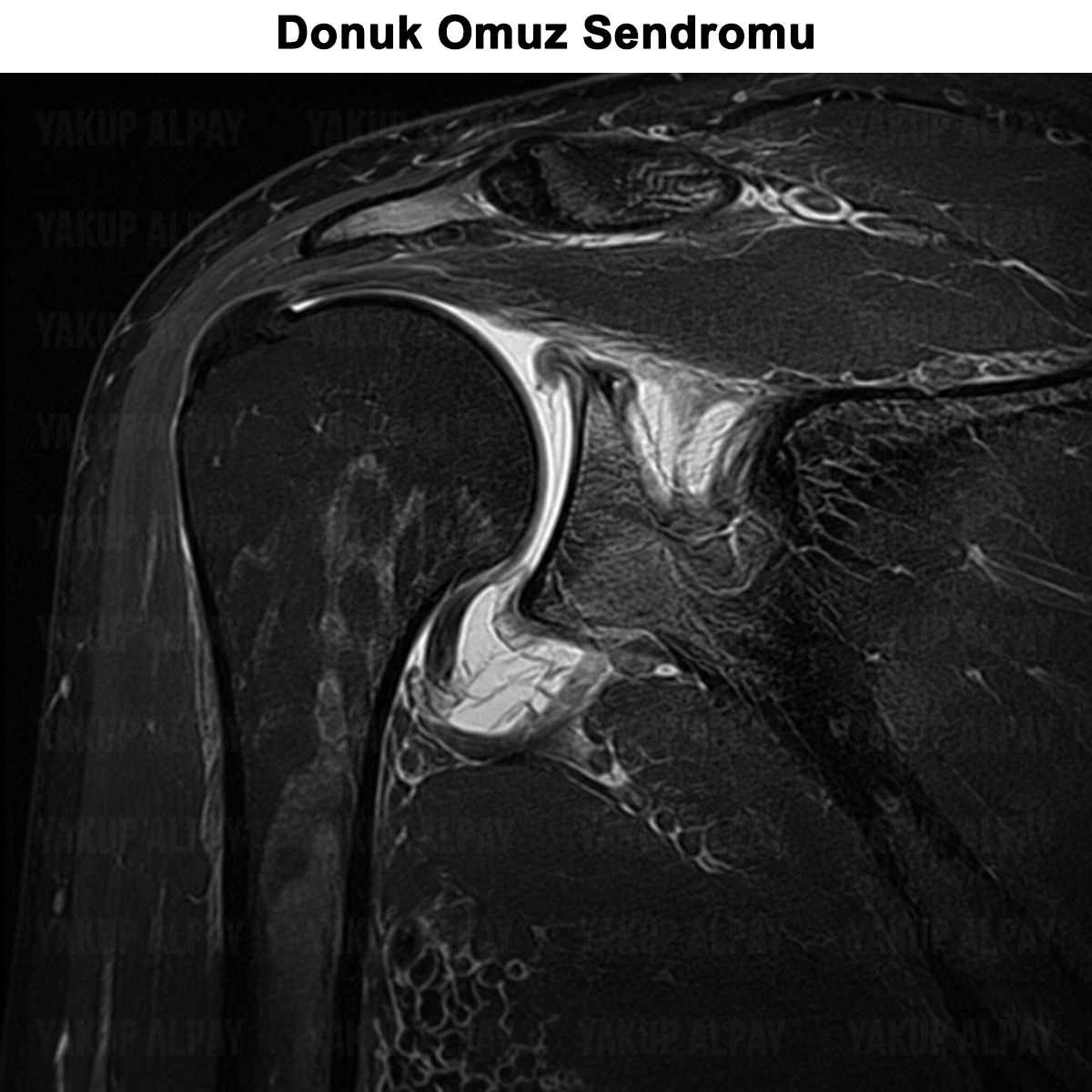 Donuk Omuz (Adeziv Kapsülit) Nedir? Tedavisi ve Ameliyatı