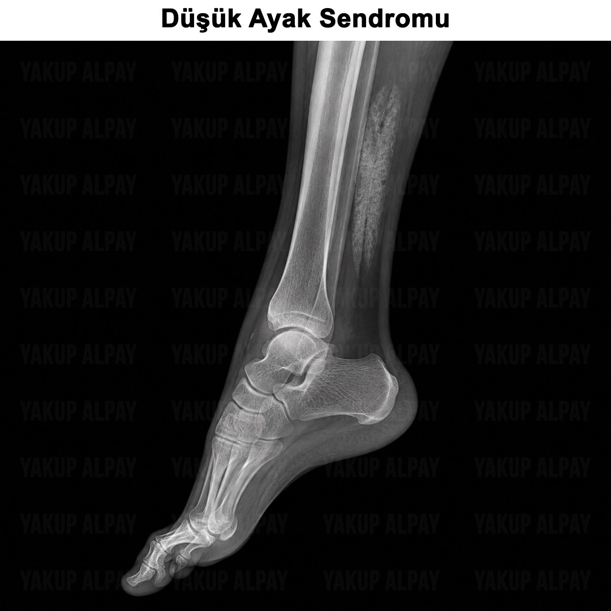 Düşük Ayak: Nedenleri, Teşhisi, Tedavisi ve Ameliyatı