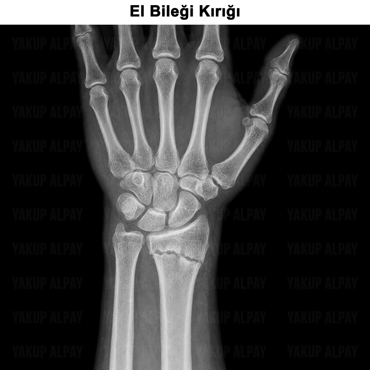 El Bileği Kırığı: Nedir? Belirtileri, Tedavisi ve Ameliyatı