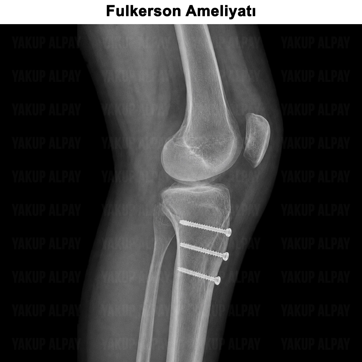Fulkerson Ameliyatı: Nedir? Nasıl Yapılır? Riskli mi?