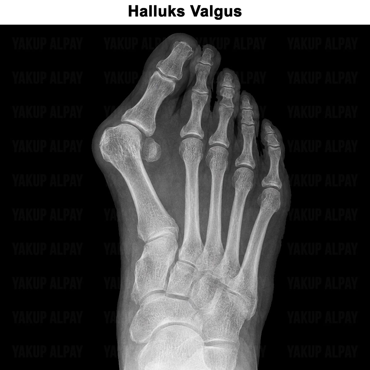 Halluks Valgus: Neden Olur? Egzersizleri ve Ameliyatı