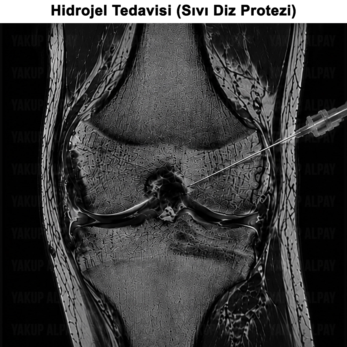 Hidrojel Tedavisi: Nedir? Kimlere Uygulanmaz? Kalıcı mı?