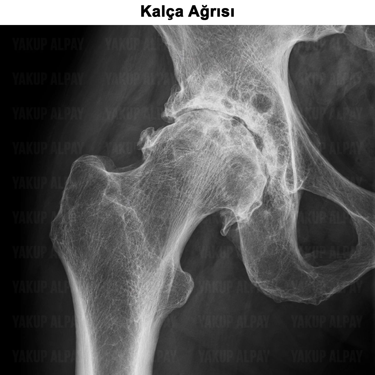 Kalça Ağrısı: Neden Olur? Egzersizleri ve Tedavisi