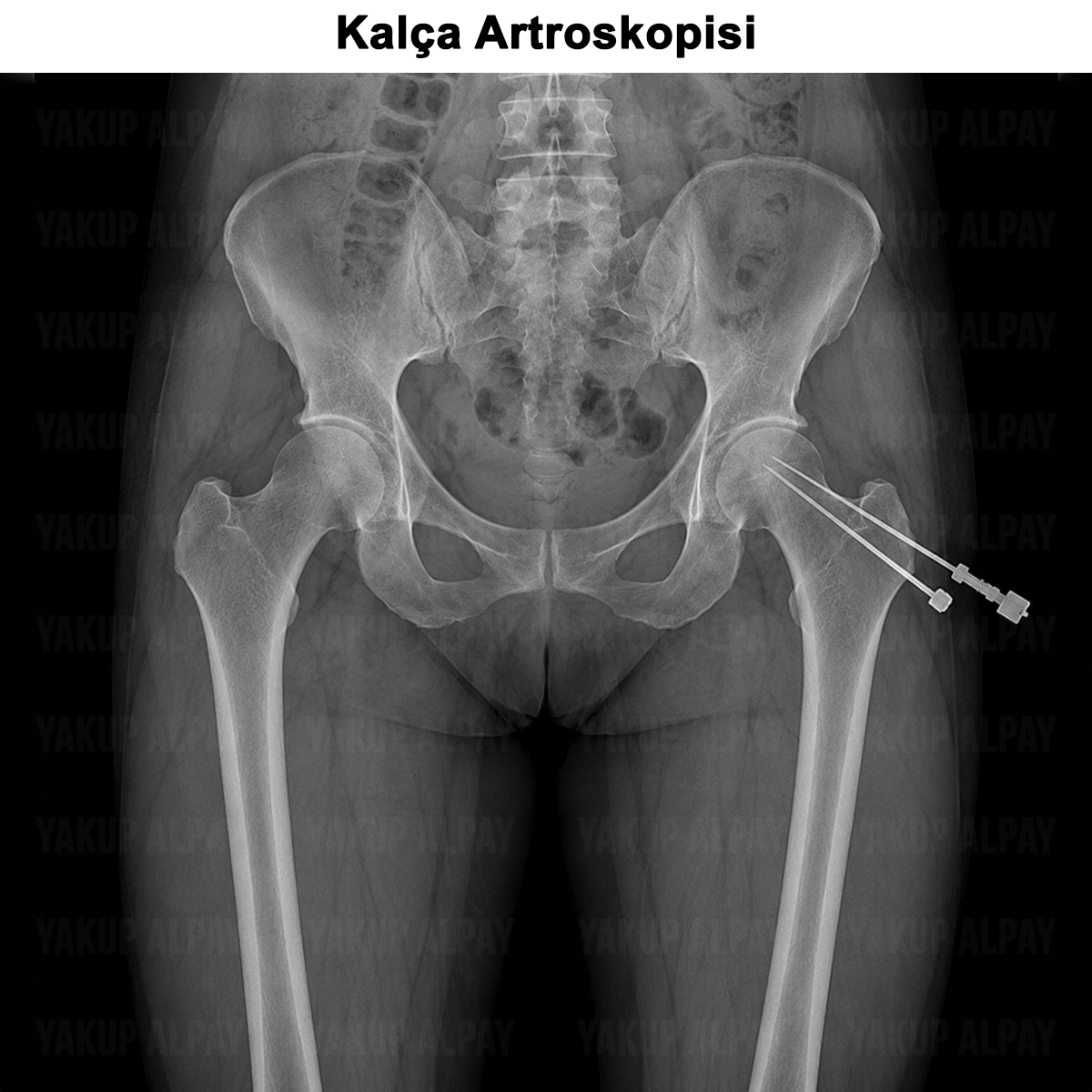 Kalça Artroskopisi: Kimlere Uygulanır? Nasıl Yapılır?