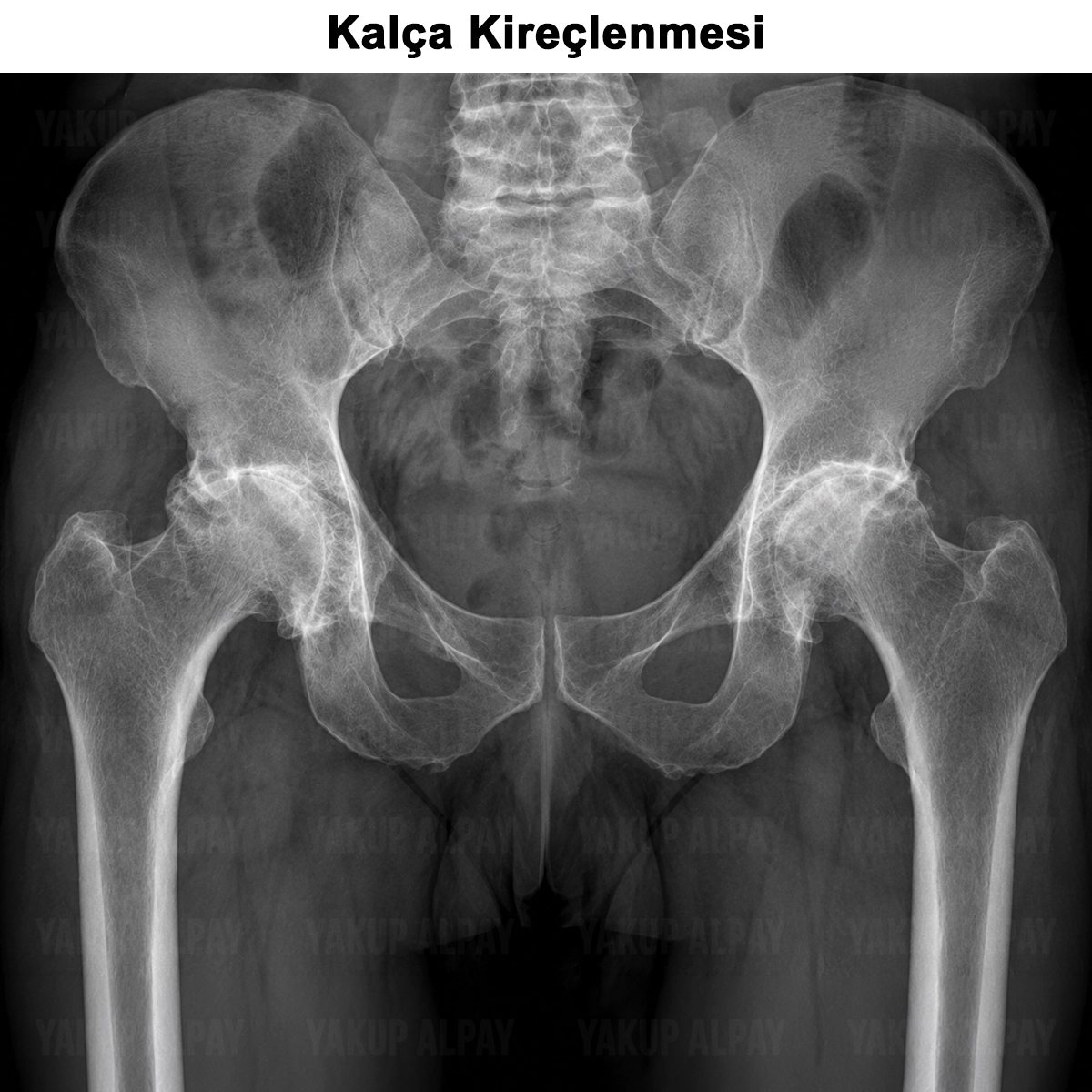 Kalça Kireçlenmesi