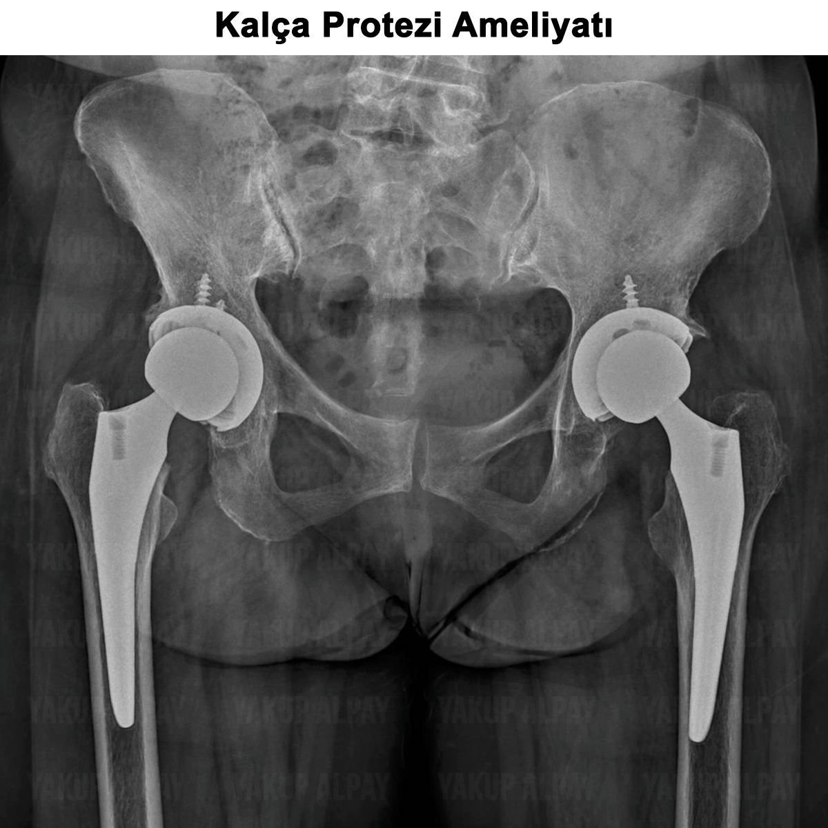 Kalça Protezi Ameliyatı: Kimlere Uygulanır? Nasıl Yapılır?