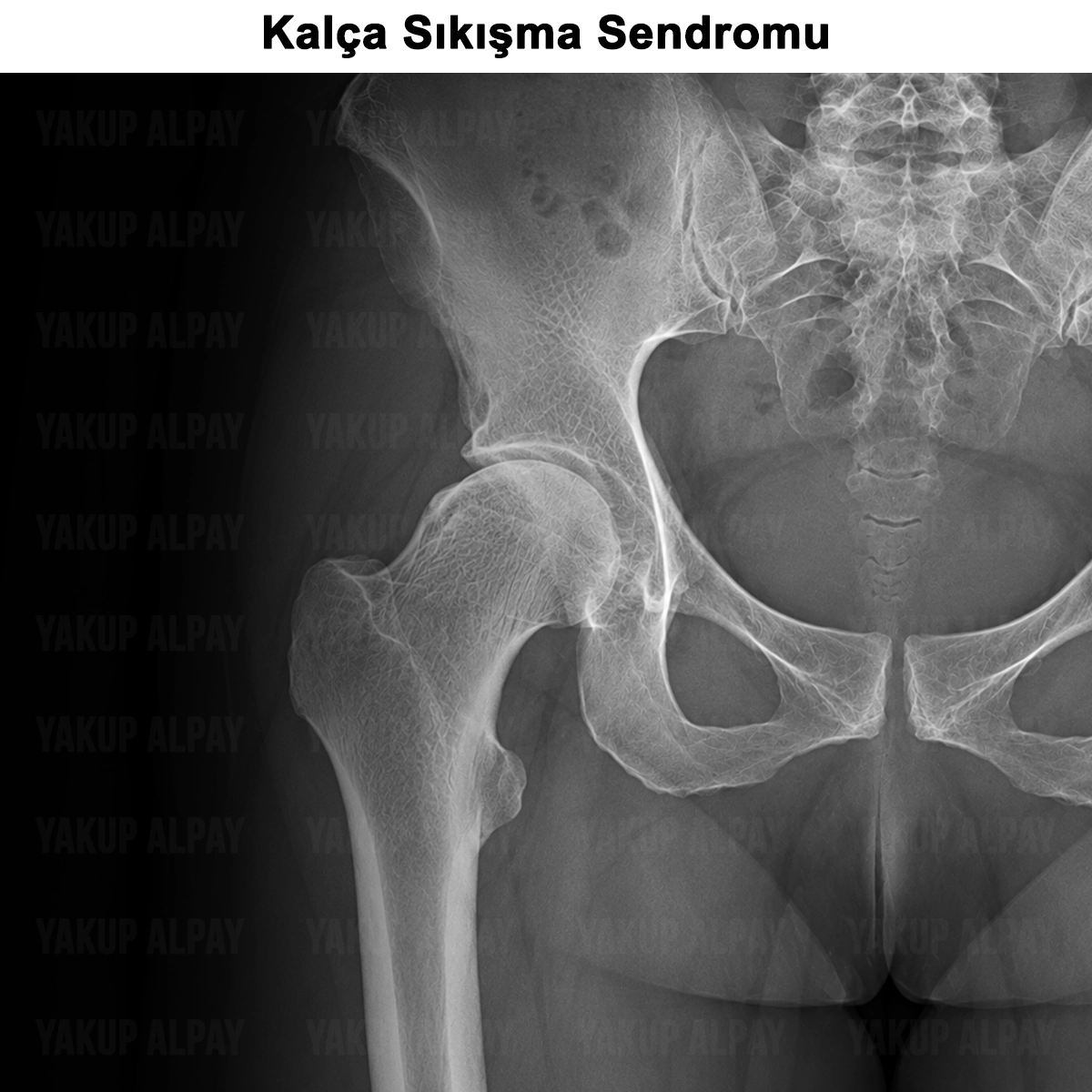 Kalça Sıkışma Sendromu: Nedir? Tedavisi? Ameliyatı?