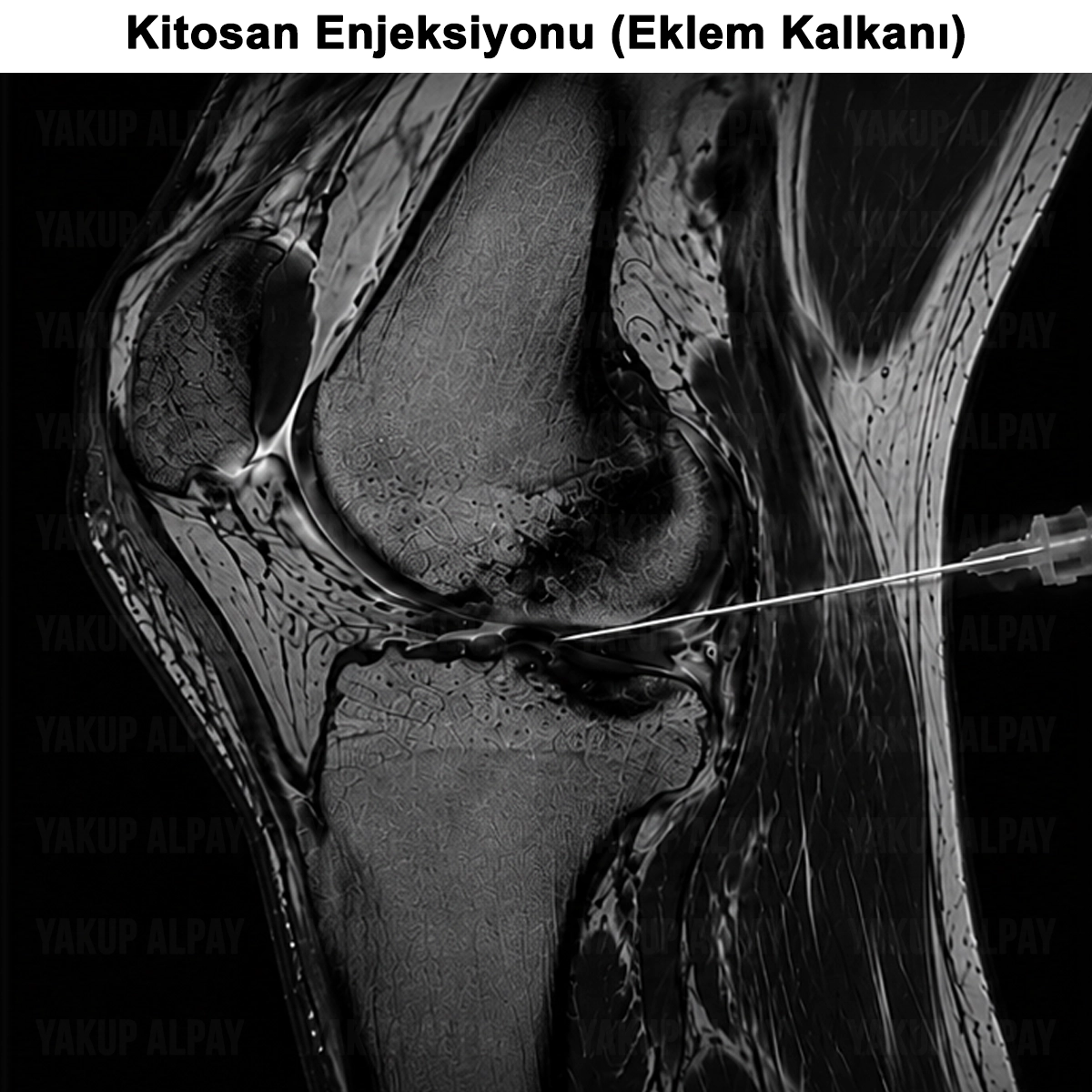 Kitosan Enjeksiyonu (Eklem Kalkanı): Etkisi ve Yan Etkileri