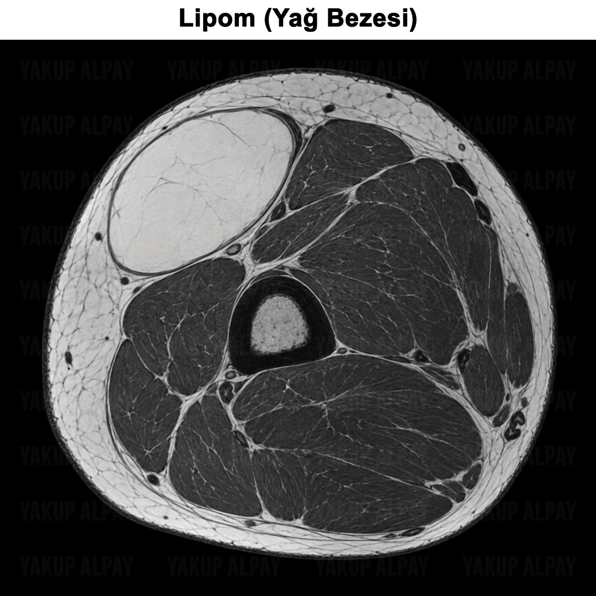 Lipom (Yağ Bezesi): Belirtileri, Tedavisi ve Ameliyatı