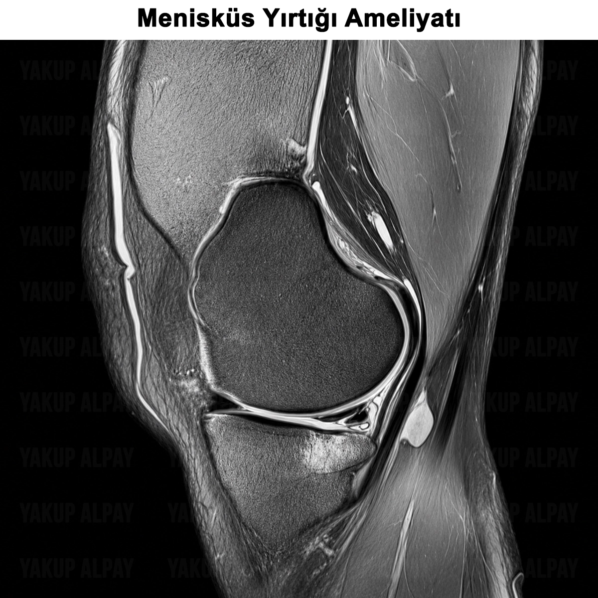 Menisküs Yırtığı: Nedir? Belirtileri? Tedavisi ve Ameliyatı