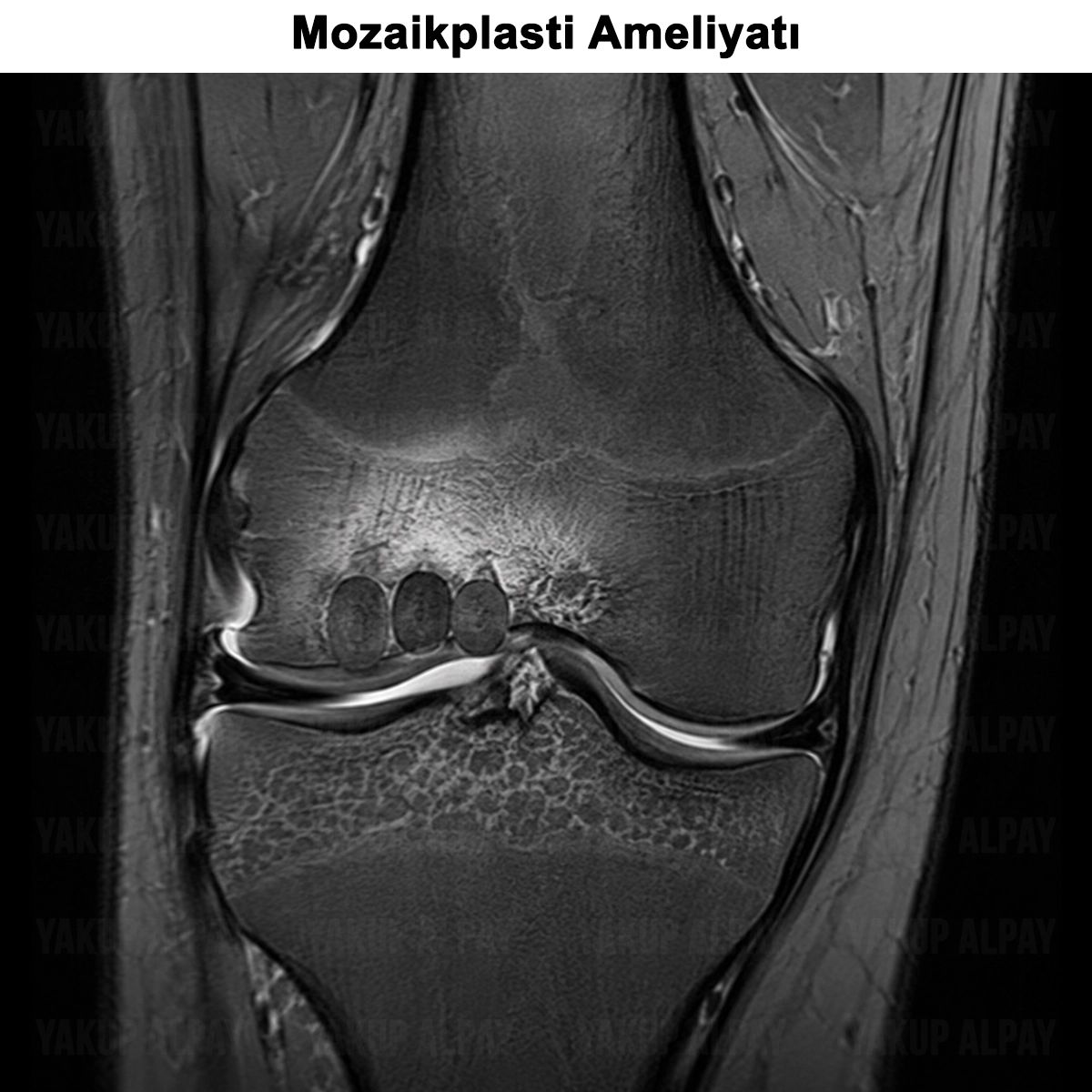 Mozaikplasti Ameliyatı: Nedir? Nasıl Yapılır?