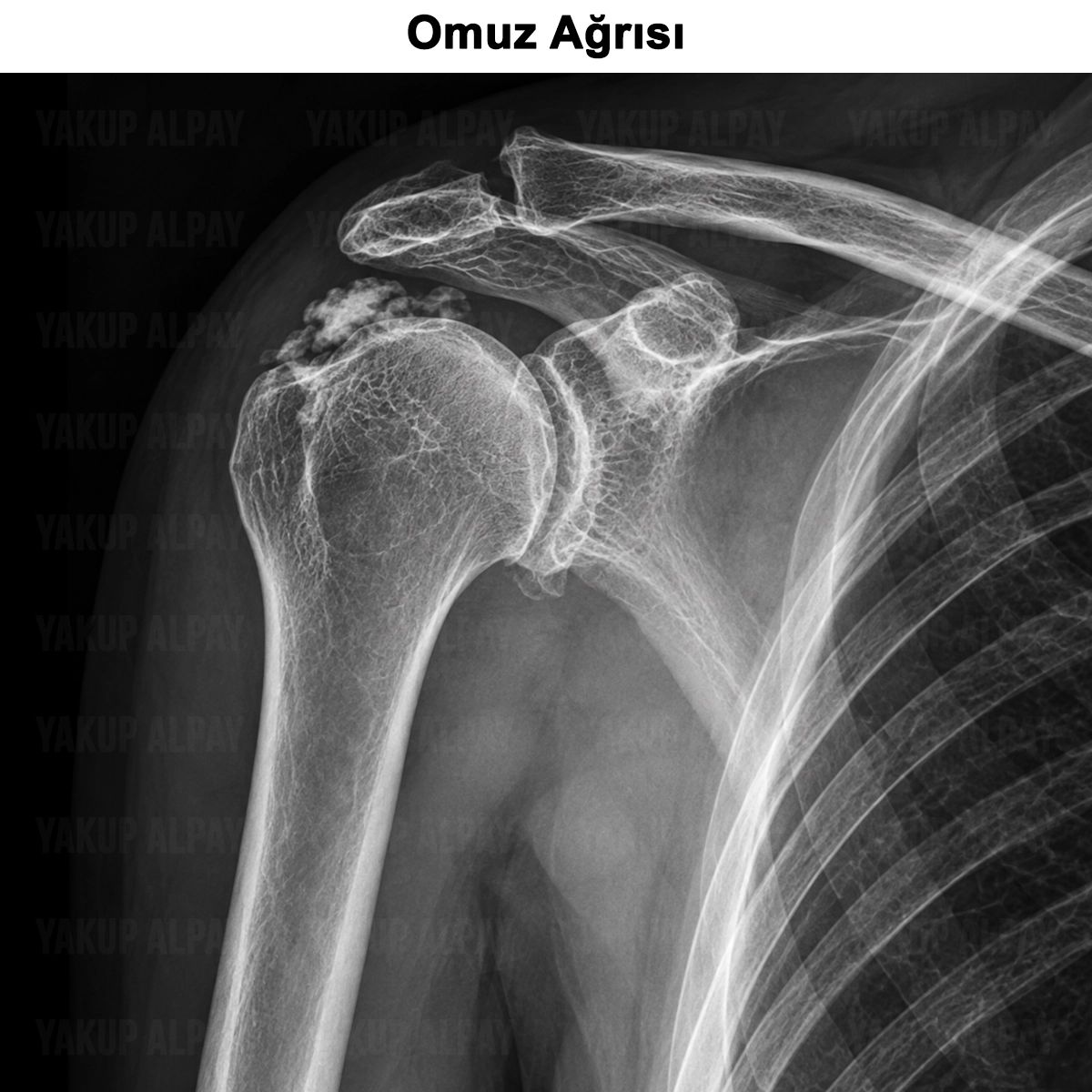 Omuz Ağrısı: Neden Olur? Nasıl Geçer? Tedavisi Nasıldır?