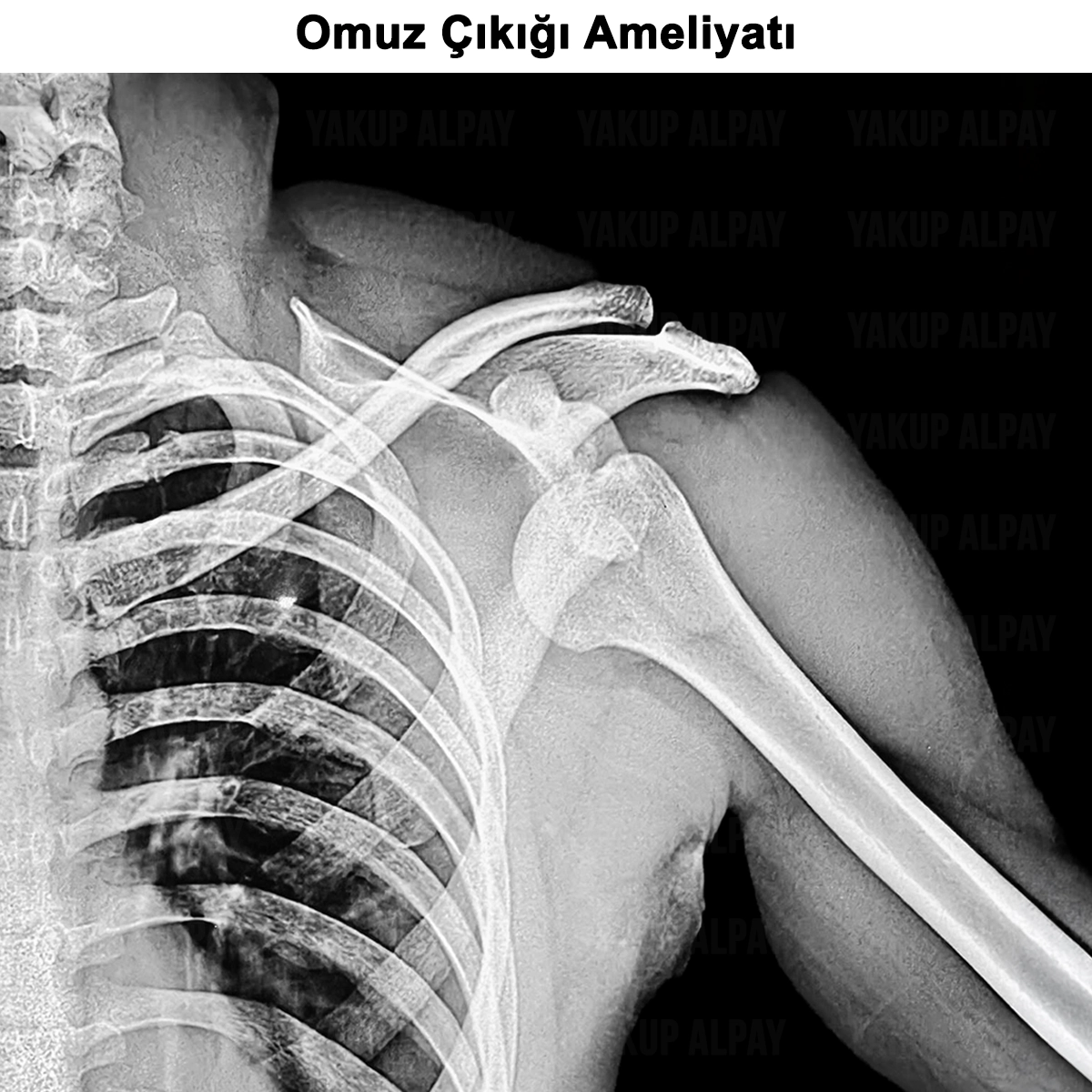 Omuz Çıkığı Ameliyatı: Nedir? Nasıl Yapılır? Riskleri?