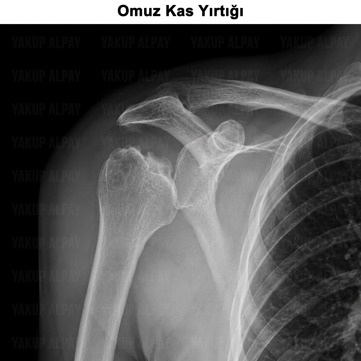 Omuz Kas Yırtığı (Rotator Cuff): Nedir? Tipleri ve Tedavisi