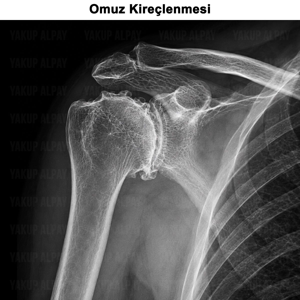 Omuz Kireçlenmesi: Belirtileri, Tedavisi ve Ameliyatı