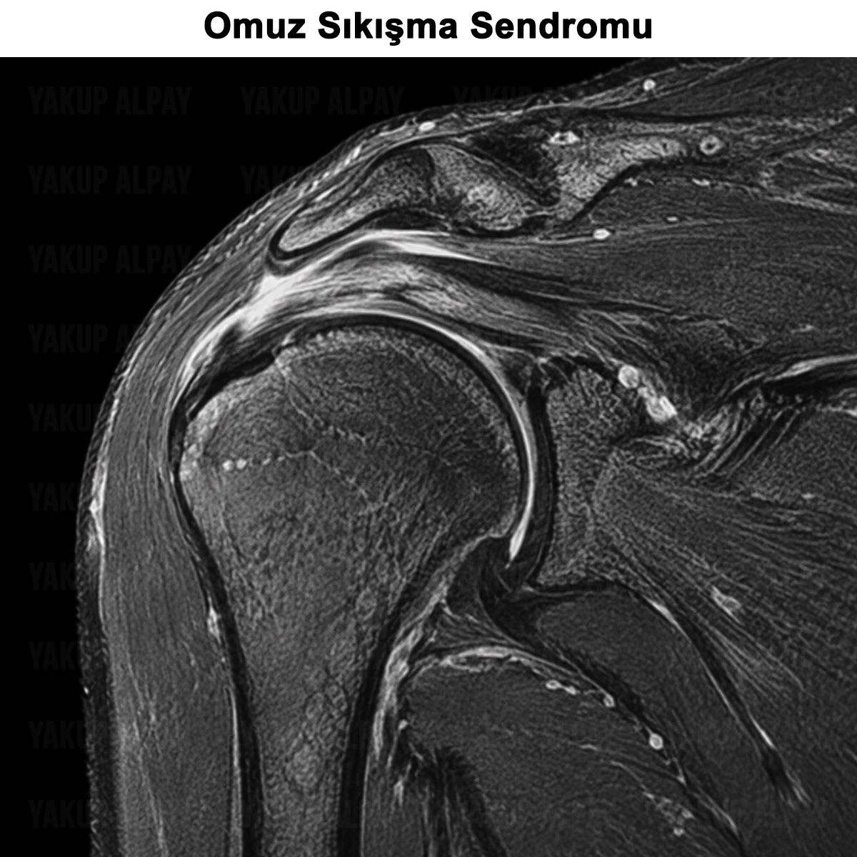 Omuz Sıkışma Sendromu: Belirtileri, Teşhisi ve Ameliyatı