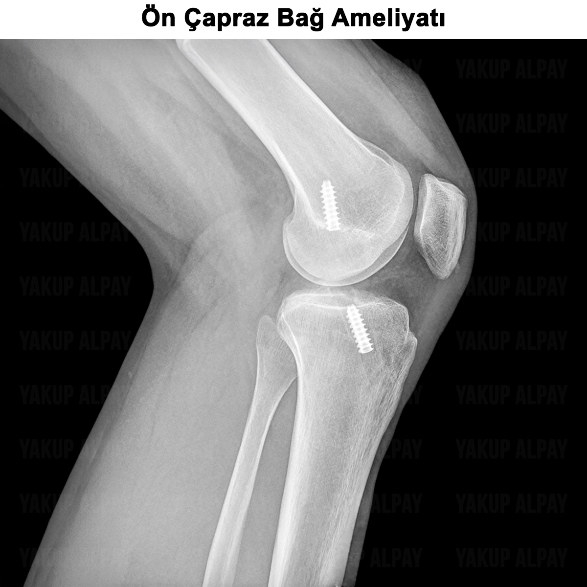 Ön Çapraz Bağ Ameliyatı