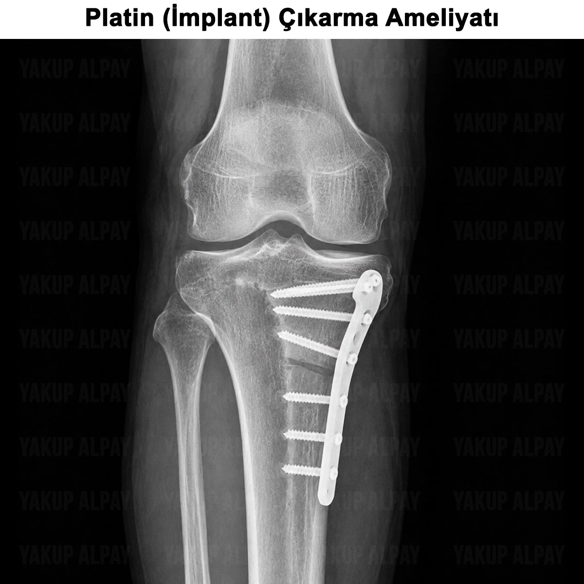 Platin (İmplant): Ne Zaman Çıkarılır? Ameliyatı ve Fiyatı