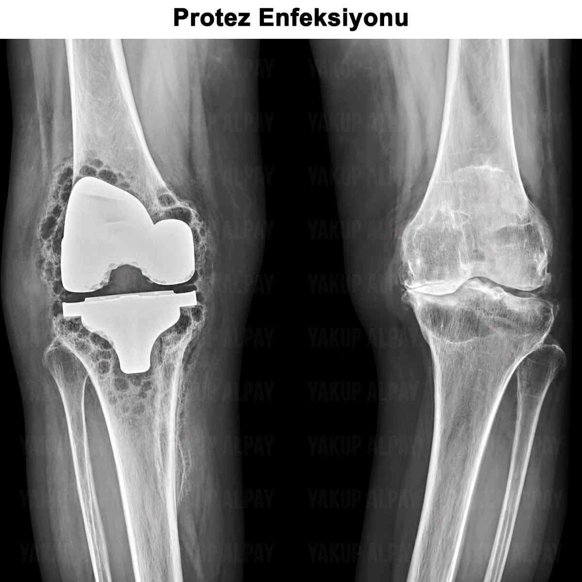 Protez Enfeksiyonu: Nedir? Nasıl Önlenir? Tedavisi?