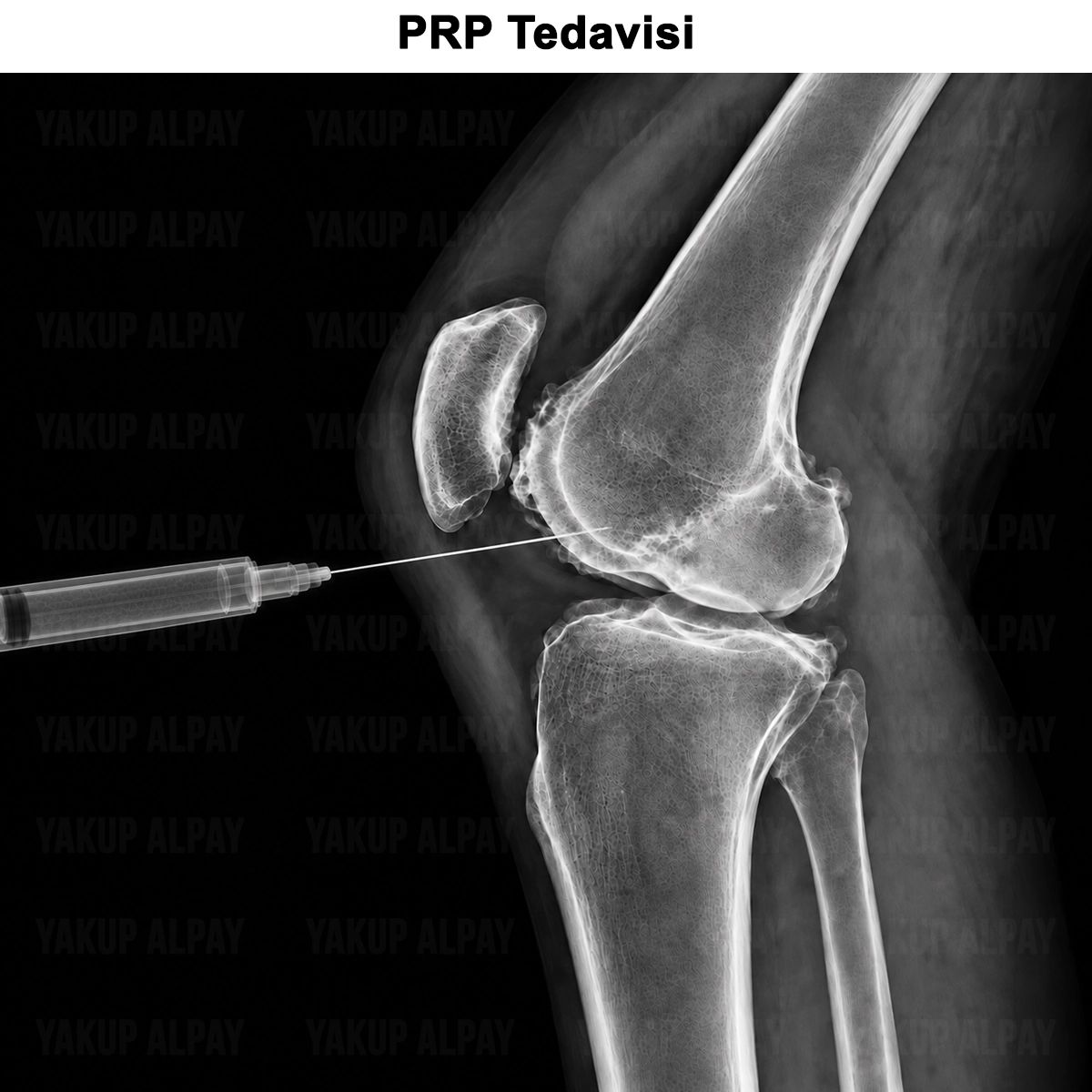 PRP Tedavisi: Nedir? Ne İşe Yarar? Nasıl Uygulanır?