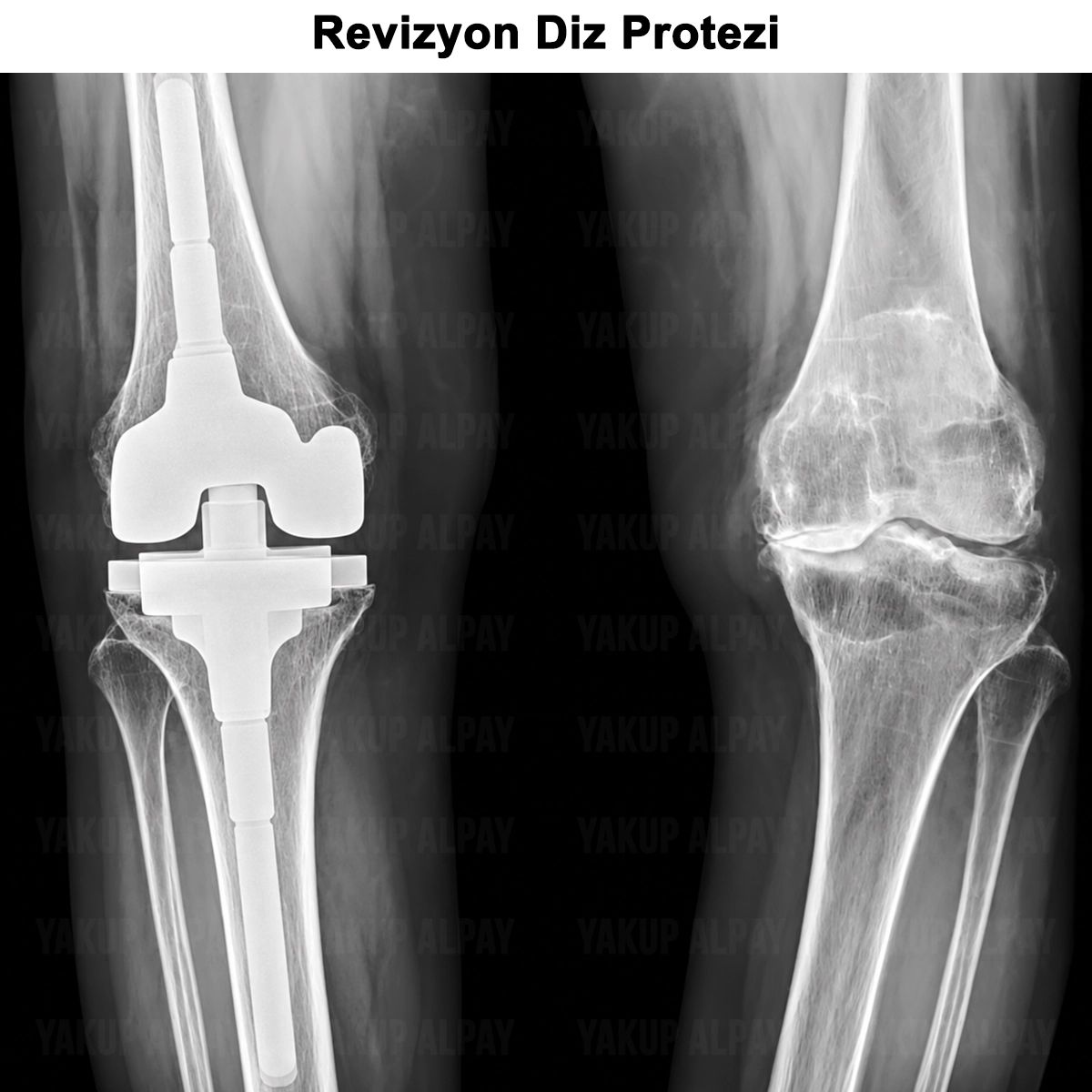 Revizyon Diz Protezi: Ne Zaman Gerekir? Nasıl Yapılır?