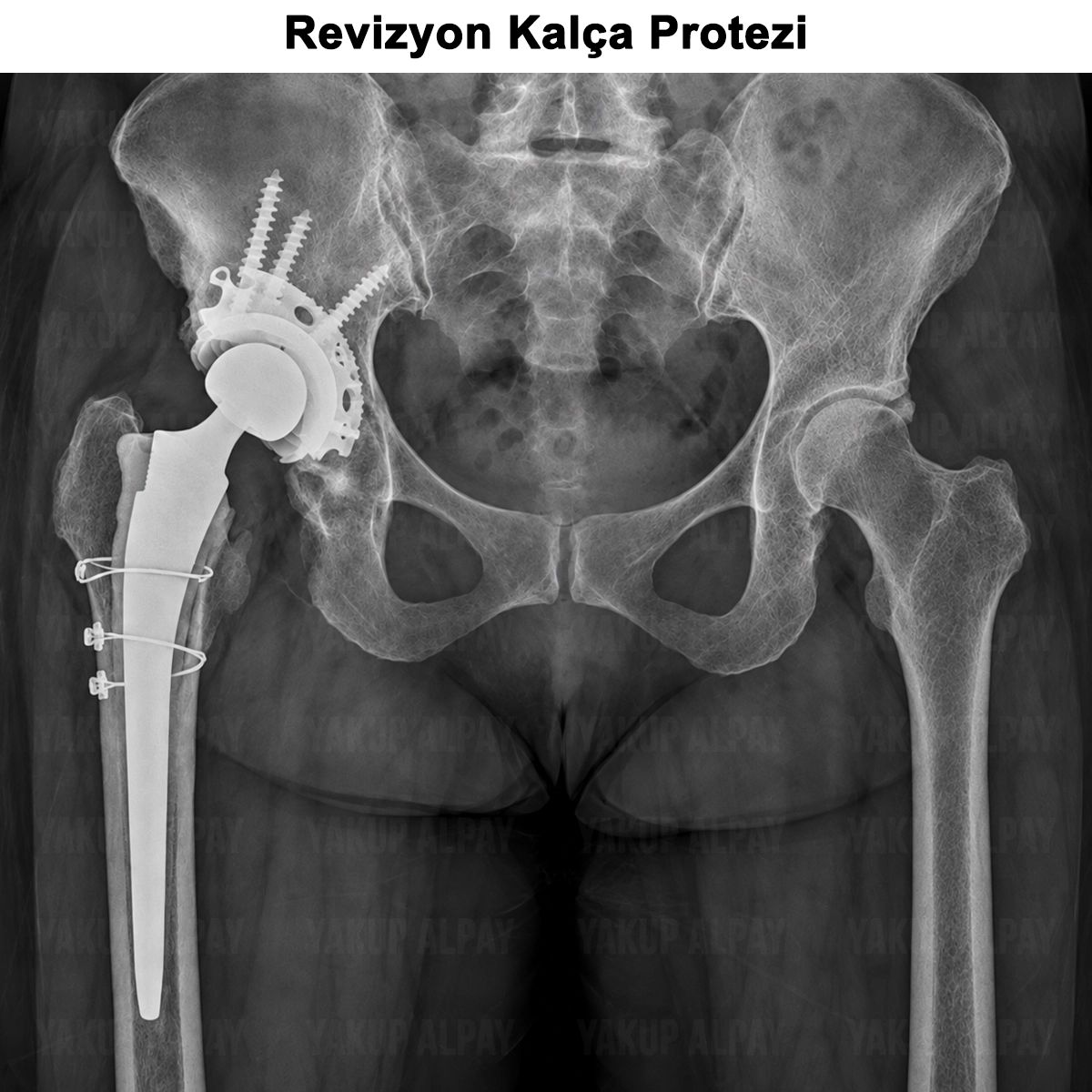 Revizyon Kalça Protezi: Erken ve Geç Dönem, İyileşme Süreci