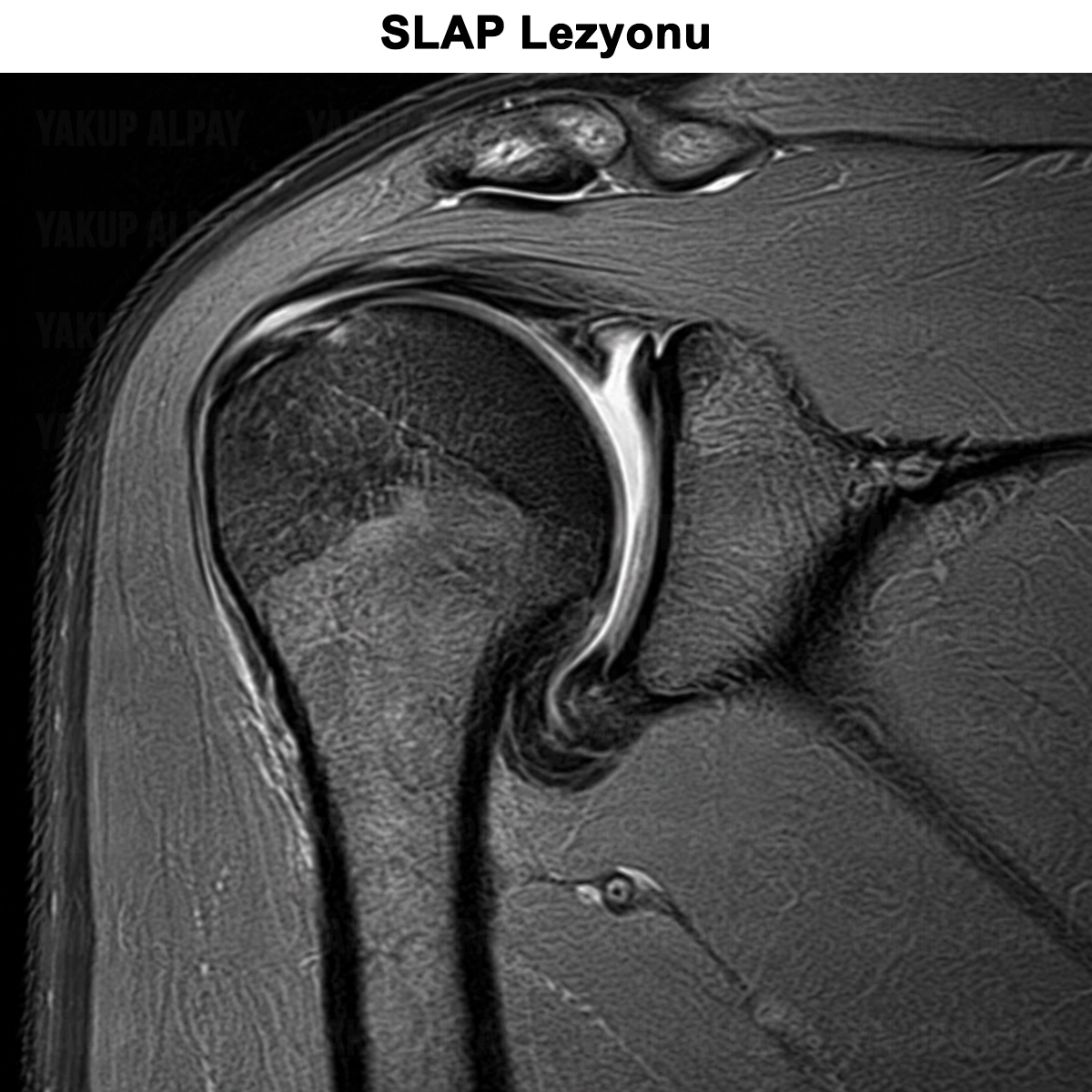 SLAP Lezyonu: Nedir? Teşhisi? Tedavisi ve Ameliyatı