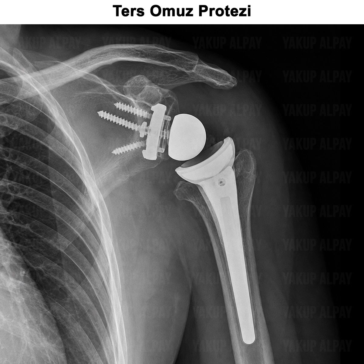 Ters (Reverse) Omuz Protezi Ameliyatı: İyileşme ve Yorumlar