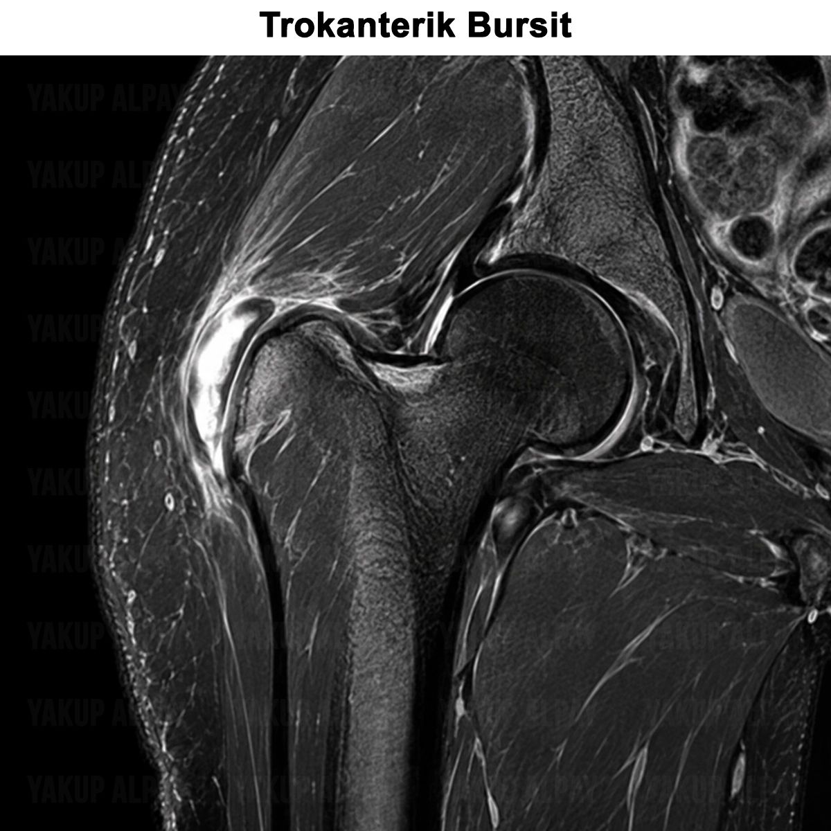 Trokanterik Bursit: Belirtileri, Tedavisi ve Ameliyatı
