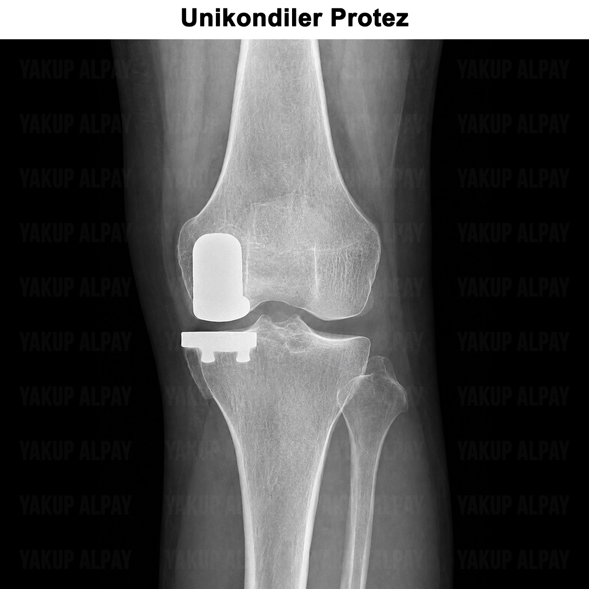 Unikondiler Protez Ameliyatı: Nedir? Neden Tercih Edilir?