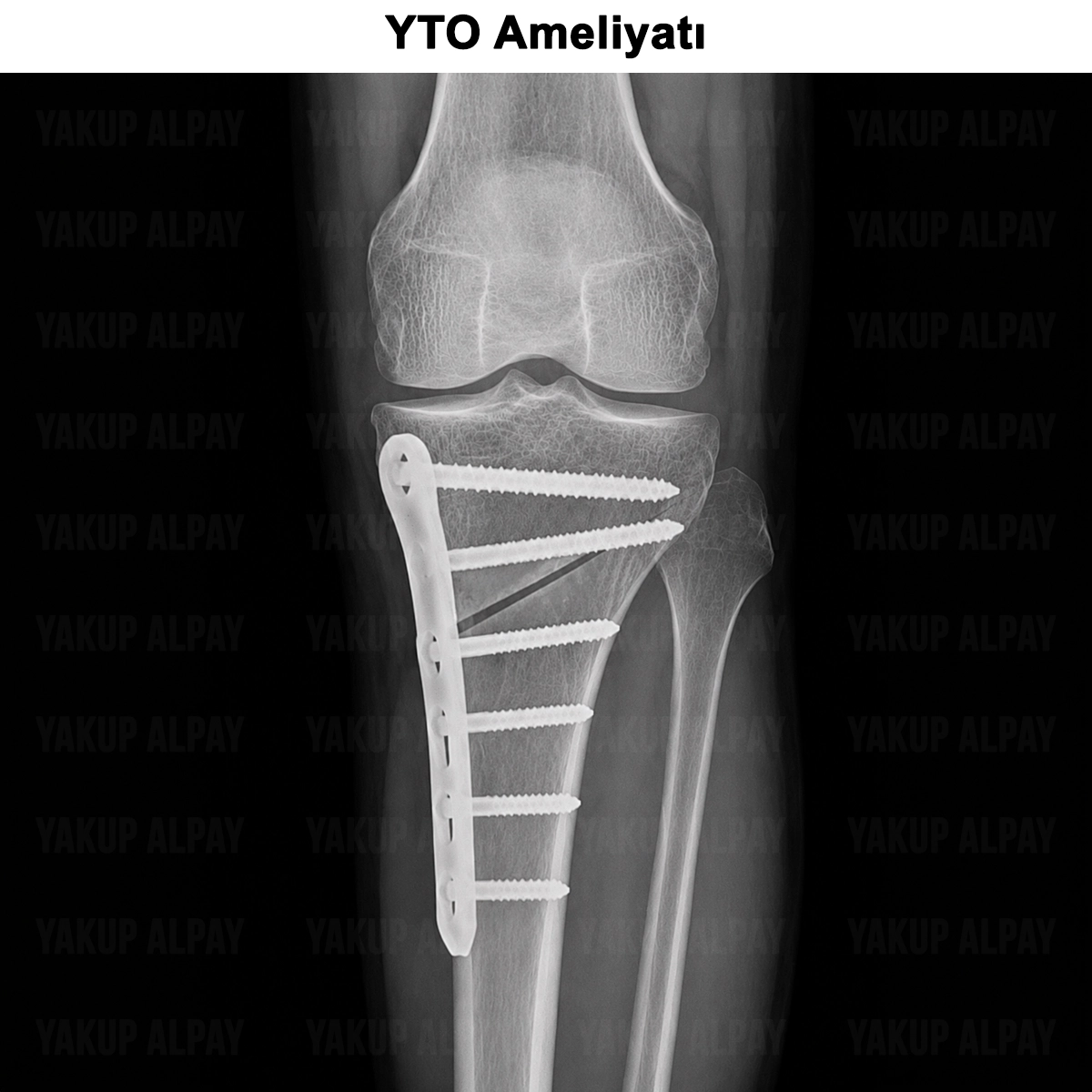 YTO Ameliyatı: Kimlere Uygulanır? Nasıl Yapılır? Riskleri?